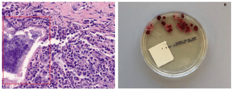 Figure 2. (A) Hematoxylin and eosin stain showing presence of sulfur granules as shown in red rectangular area. Magnification 200×. (B) Figure showing colony morphology in fungal culture with Sabouraud Dextrose agar.