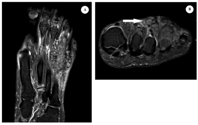 Figure 1. Magnetic resonance imaging (MRI) findings. (A) Coronal T2-weighted MRI image revealing an infiltrative multi-cystic mass along the dorsal aspect for the fourth metatarsophalangeal joint. (B) Axial view T2-weighted MRI image with ‘dot-in-a-circle’ sign as shown with the white arrow.