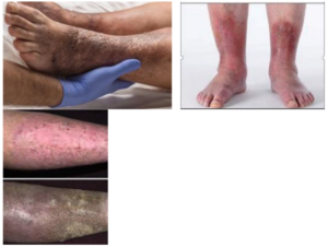 Cellulitis Look-Alikes - PPID Journal